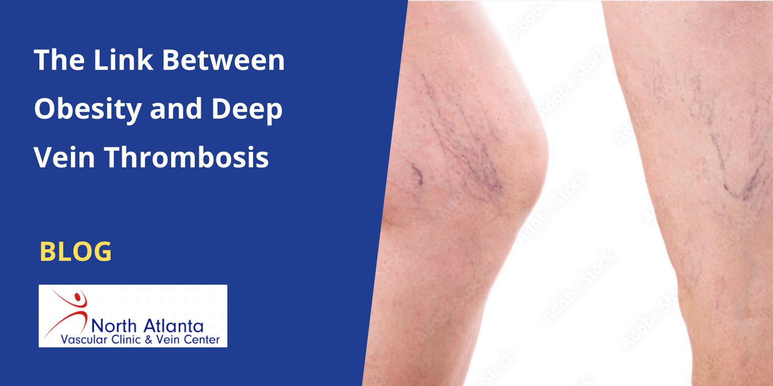 The Link Between Obesity and Deep Vein Thrombosis 