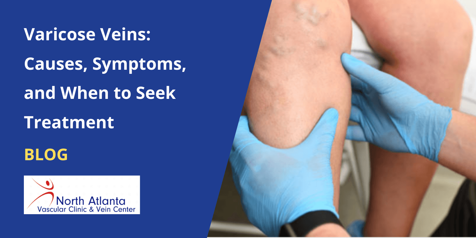 Varicose Veins: Causes, Symptoms, and When to Seek Treatment