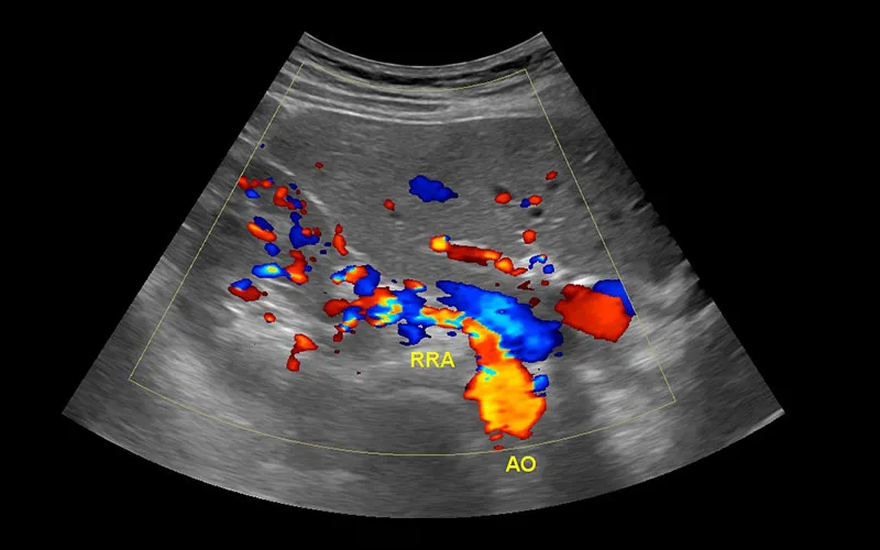 Arterial Duplex Cms