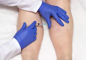 Sclerotherapy