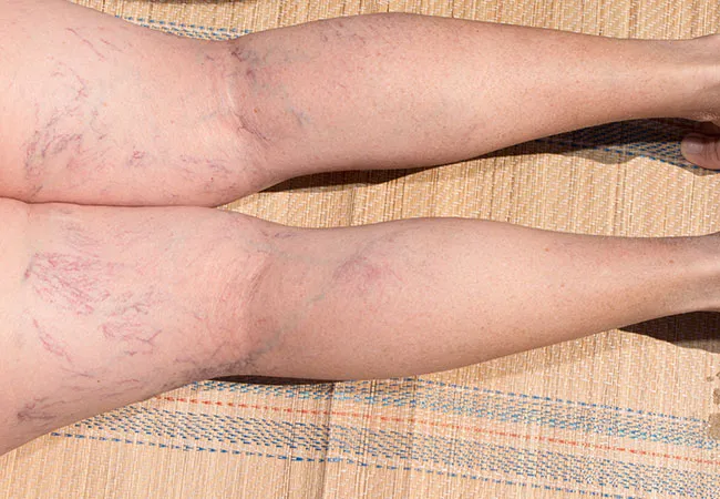 Consult Our Specialist for Sclerotherapy Treatment