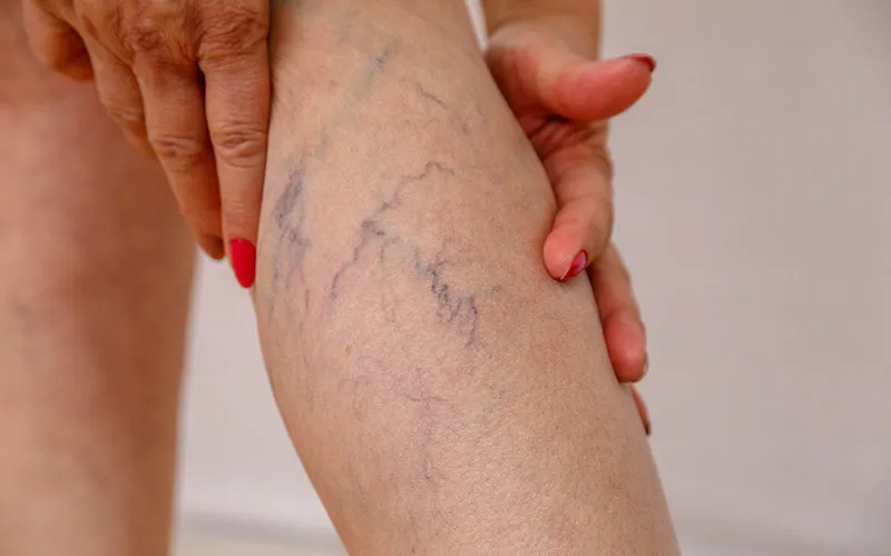 Spider Veins Specialist
