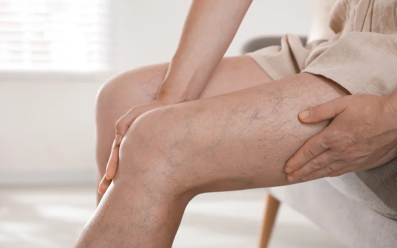 Treatment for Varicose Veins