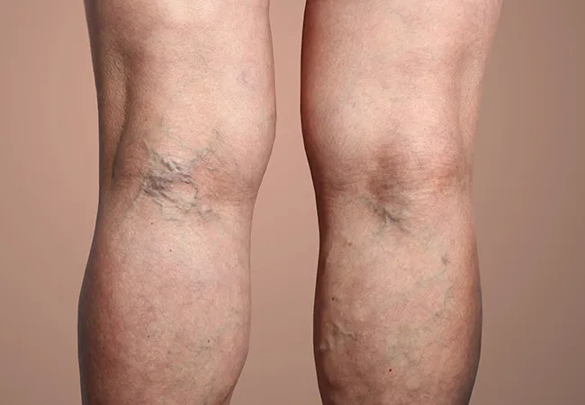 Symptoms of Varicose Veins