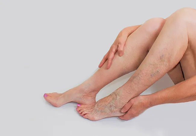 Why Choose North Atlanta Vascular Clinic for Varicose Veins Treatment?