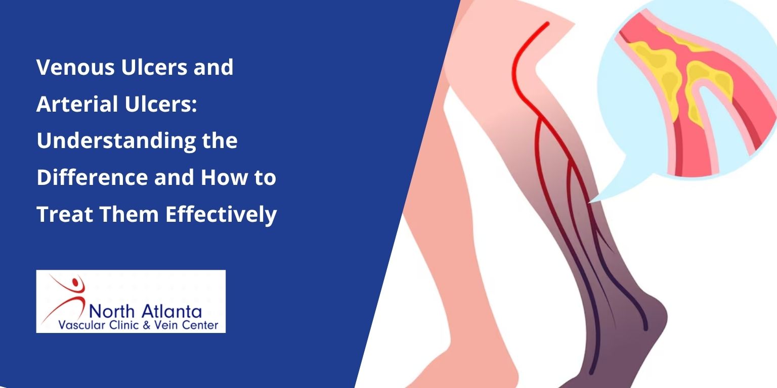 venous ulcers and arterial ulcers