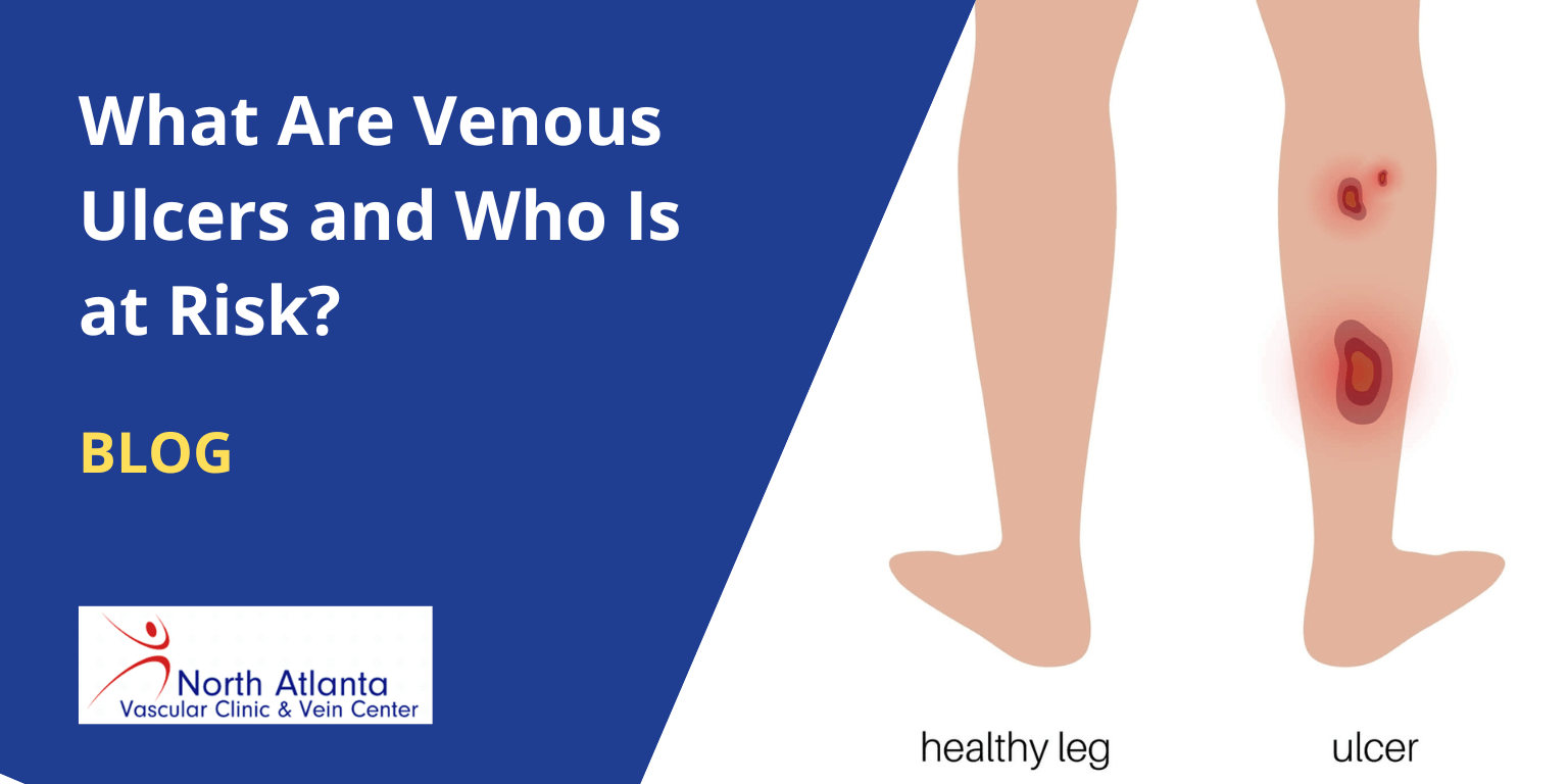 Tibia Ulcer venous ulcers - North Atlanta Vascular Clinic