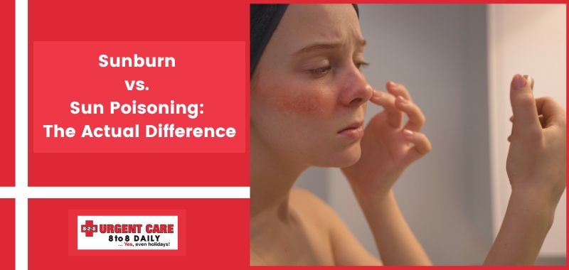 Sunburn vs. Sun Poisoning: The Actual Difference