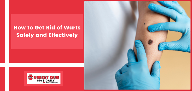 How to Get Rid of Warts Safely and Effectively