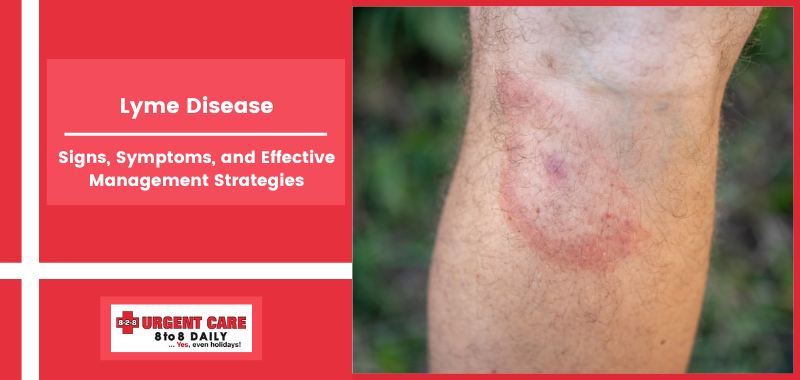 Lyme Disease: Signs, Symptoms, and Effective Management Strategies