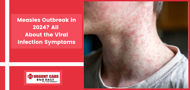 Measles Outbreak in 2024? All About the Viral Infection Symptoms
