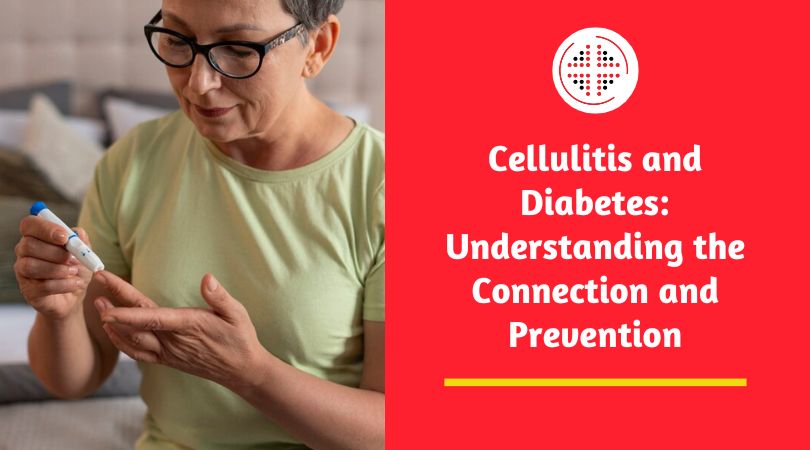 Cellulitis and Diabetes: Understanding the Connection and Prevention