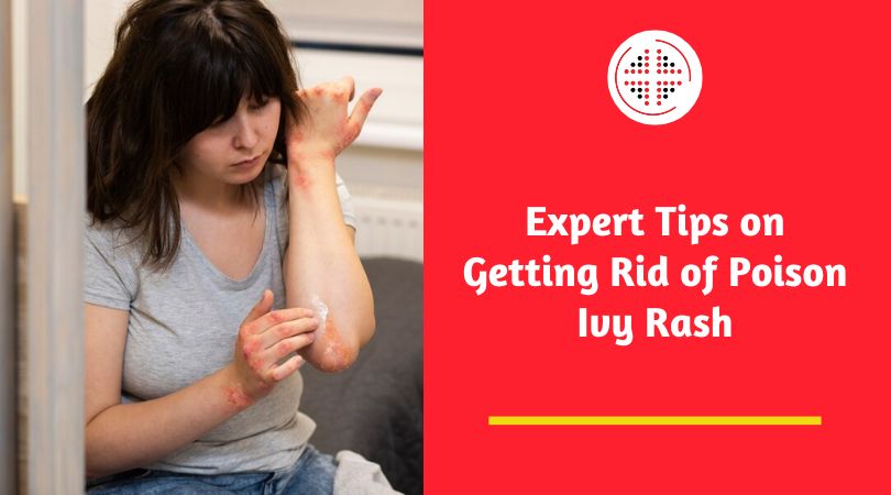 Expert Tips on Getting Rid of Poison Ivy Rash
