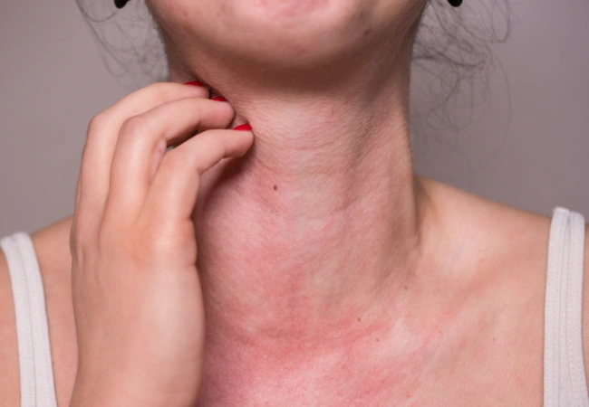 When to Seek Urgent Care for a Sunburn — MI Express Urgent Care MI