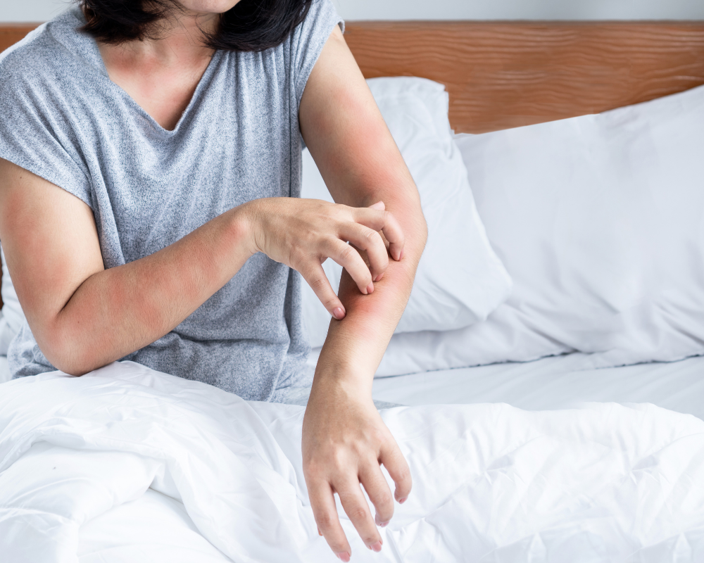 Signs and Symptoms of Oak Mite Bites