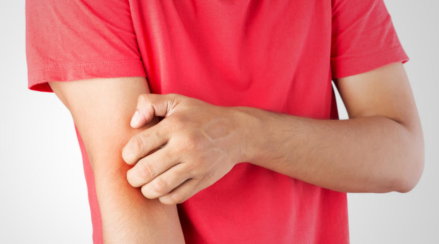Signs and Symptoms of Chigger Bites