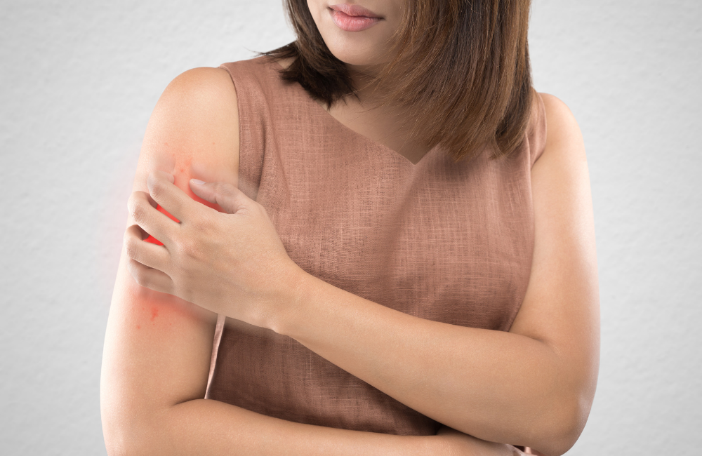 Symptoms of Sand Fly Bites