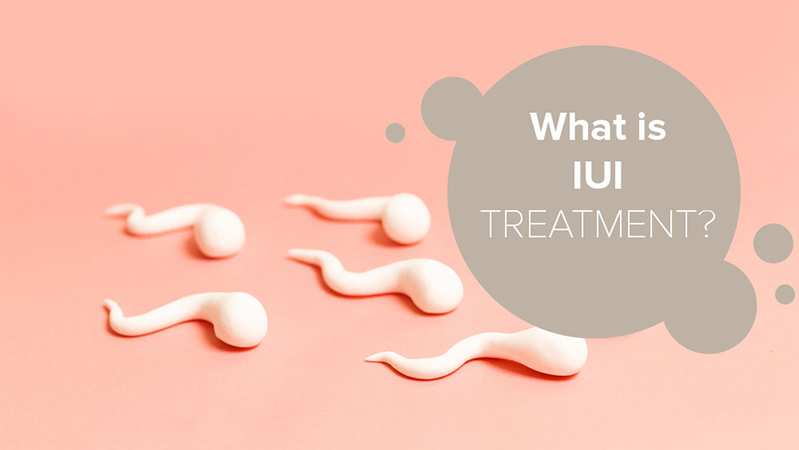 IUI treatment: the first step in the treatment of infertility
