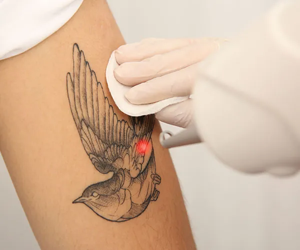 Why Choose Aria Medspa for Your Tattoo Removal in La Grange?