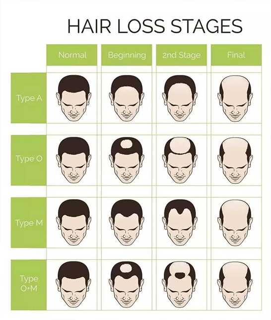 See this hair baldness chart to on which stage you are