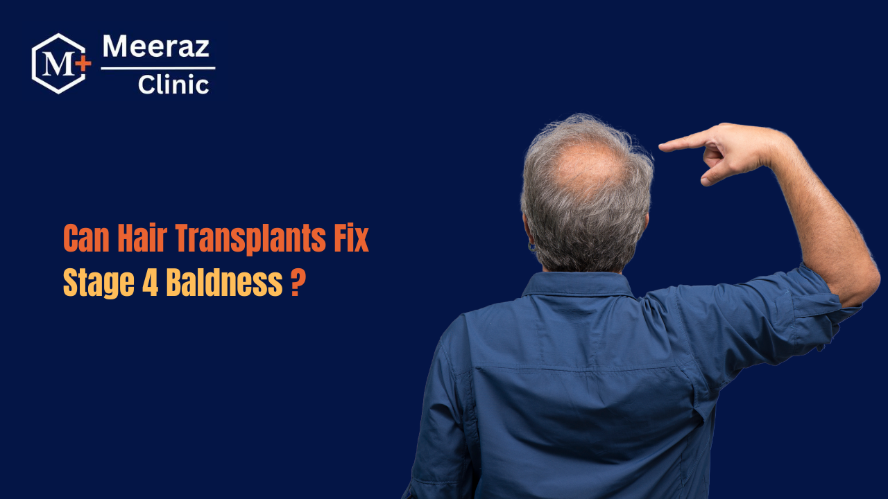 Is It Possible to Cure Stage 4 Baldness with Hair Transplants?