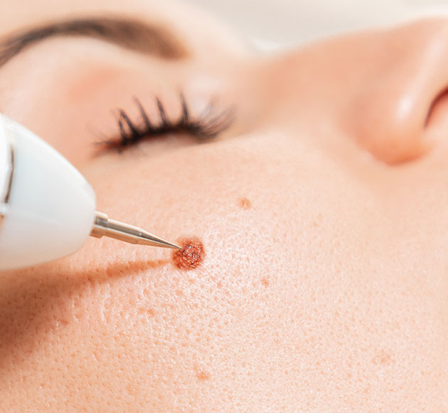 Who is the Right Candidate for Mole Removal Treatment