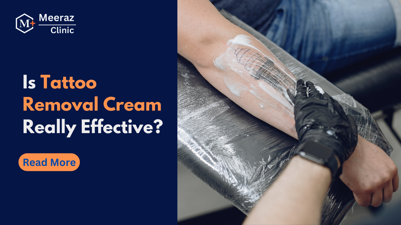 Is Tattoo Removal Cream Really Effective 