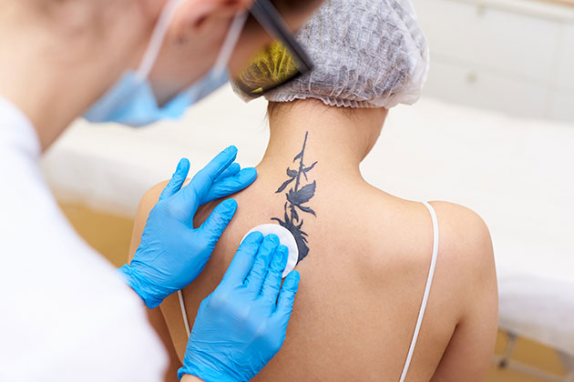 Who is the Right Candidate for Permanent Laser Tattoo Removal?