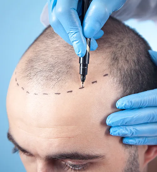 Comprehensive Hair Transplant Marketing Services