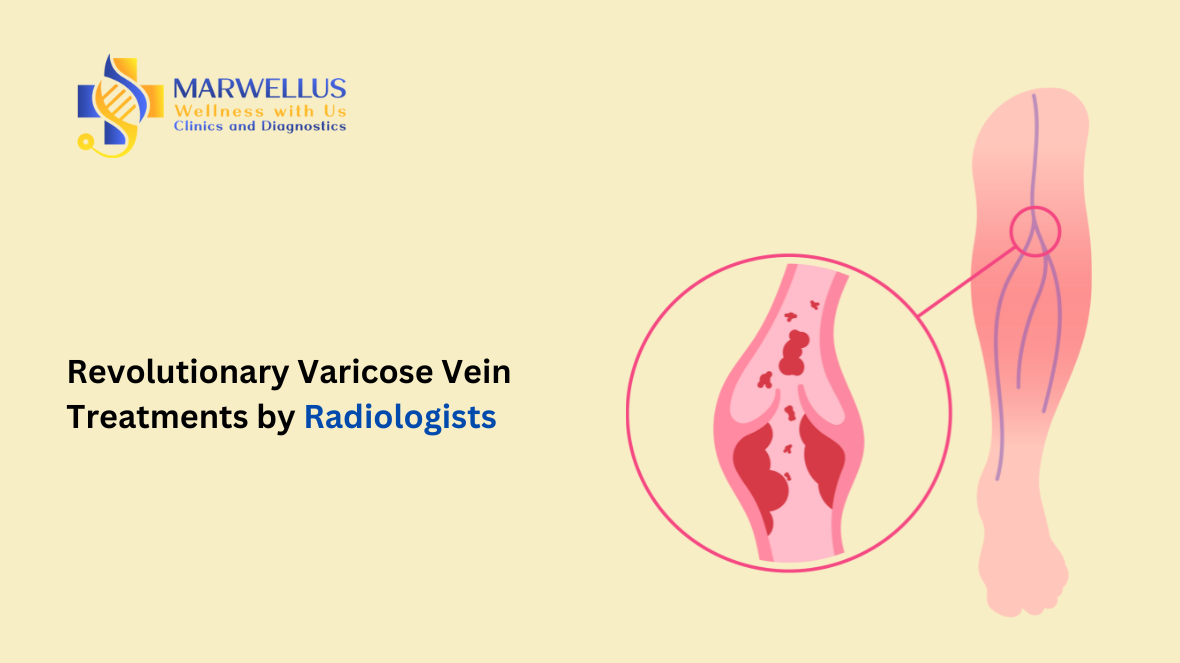 Varicose Vein