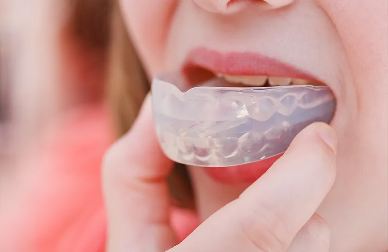 Bite Splints