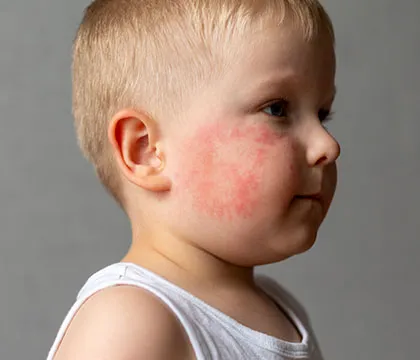 Rashes & Skin Irritations