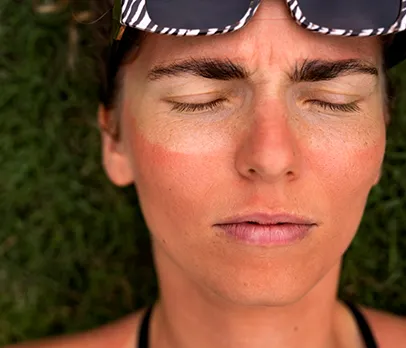 Chronic Sunburn