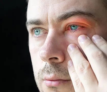 Eye Injuries