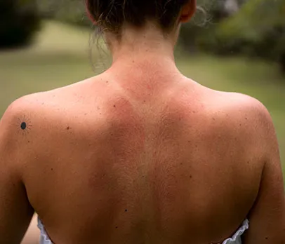 Moderate Sunburn