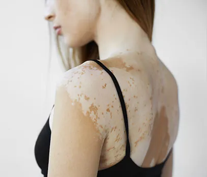 Severe Sunburn