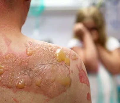 Blistering Sunburn