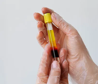 Blood in Urine (Hematuria)