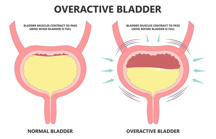Nocturnal Enuresis (Bedwetting)
