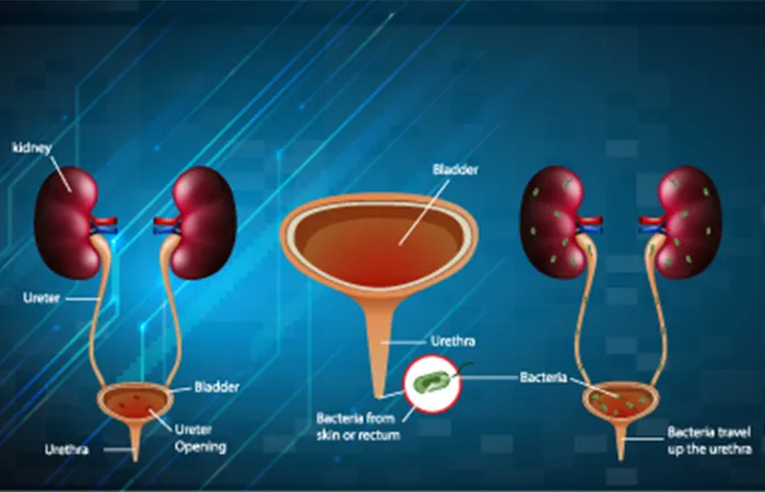 Ureteropelvic Junction (UPJ) Obstruction