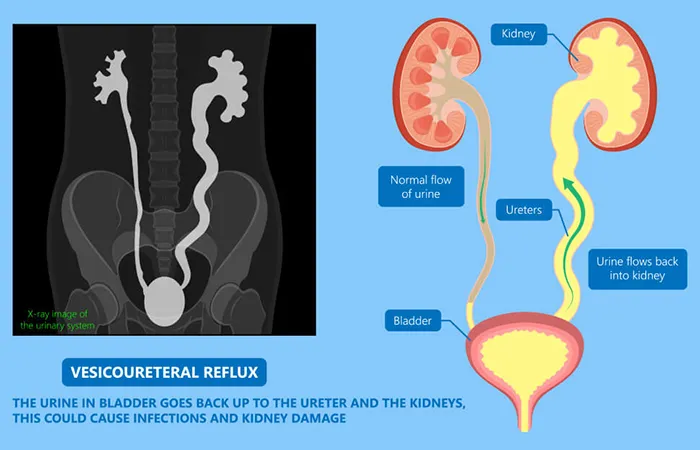Vesicoureteral Reflux (VUR)