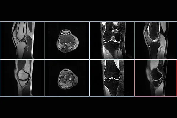 Types of Osteoid Osteoma Ablation