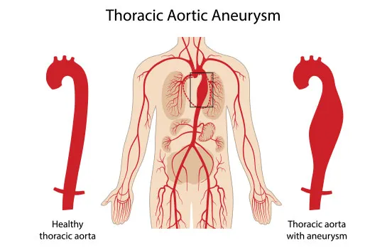 Types of Aortic Aneurysms