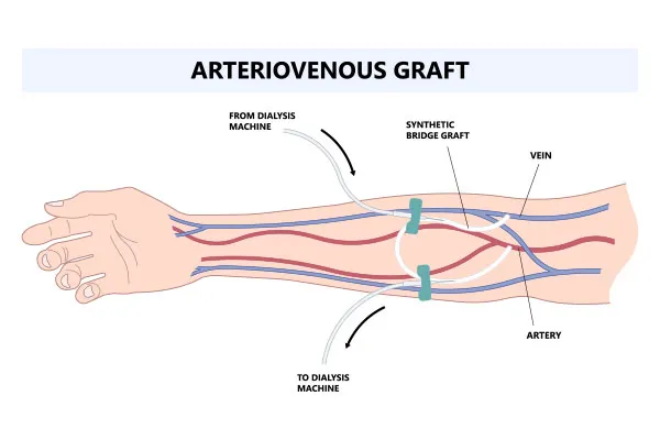 Benefits of AV Fistula Salvage