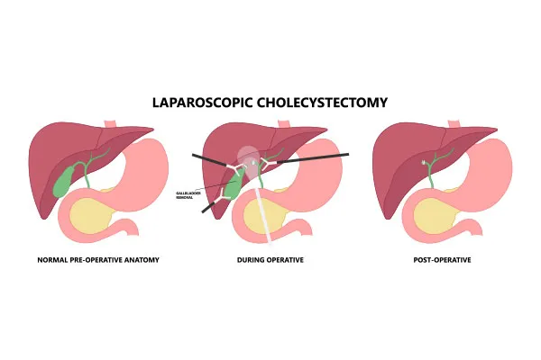 Procedure Overview