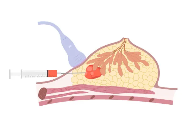 How Does the Biopsy Procedure Work?