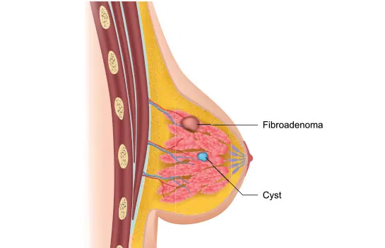 What is Breast Fibroadenoma Ablation?