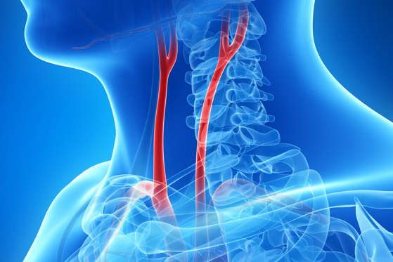 Carotid angioplasty and stenting