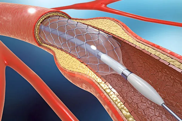 How is Intracranial Angioplasty and Stenting Performed?