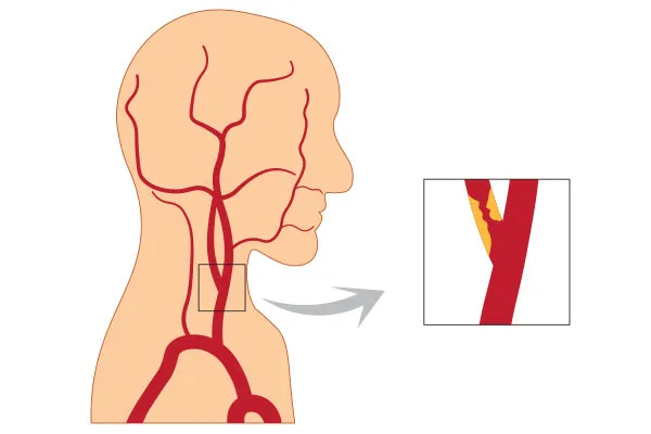 How is Carotid Artery Stenting Performed?